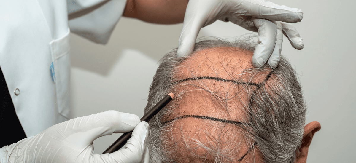 Modern Hair Restoration Tech