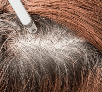 The Regenerative Power of PRP Therapy for Hair Loss