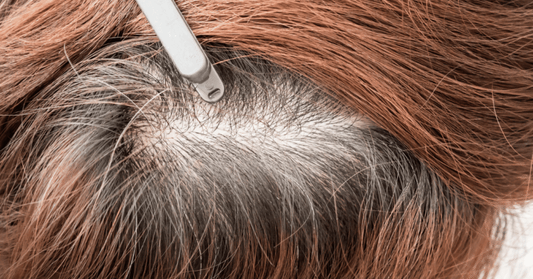 The Regenerative Power of PRP Therapy for Hair Loss